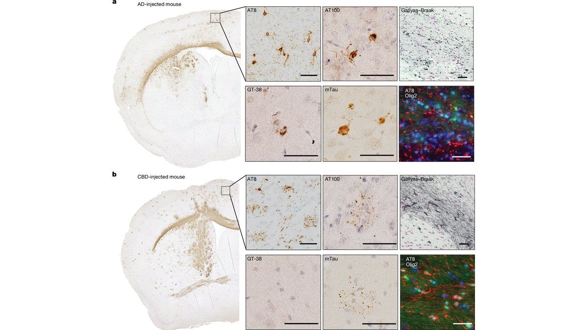 Plate of microscope images: two whole mouse brain sections stained brown, with magnified panels showing dark tau deposits in nerve cells and green and red fluorescence panels.