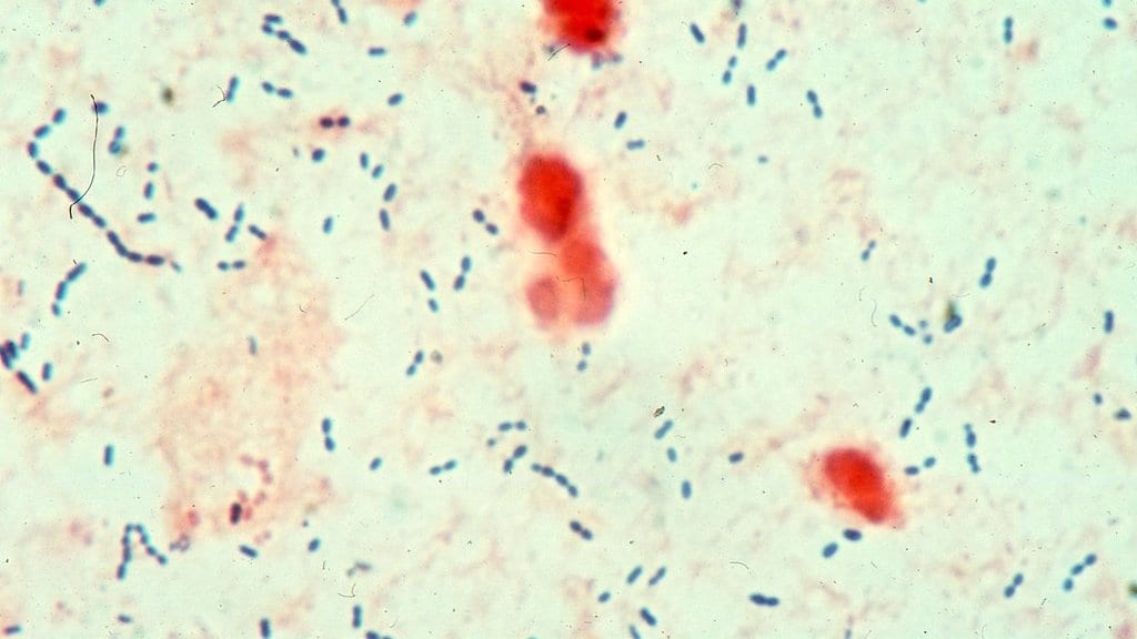 Light micrograph of a Gram-stained smear showing blue chains of Streptococcus pneumoniae bacteria scattered among pink host cells.
