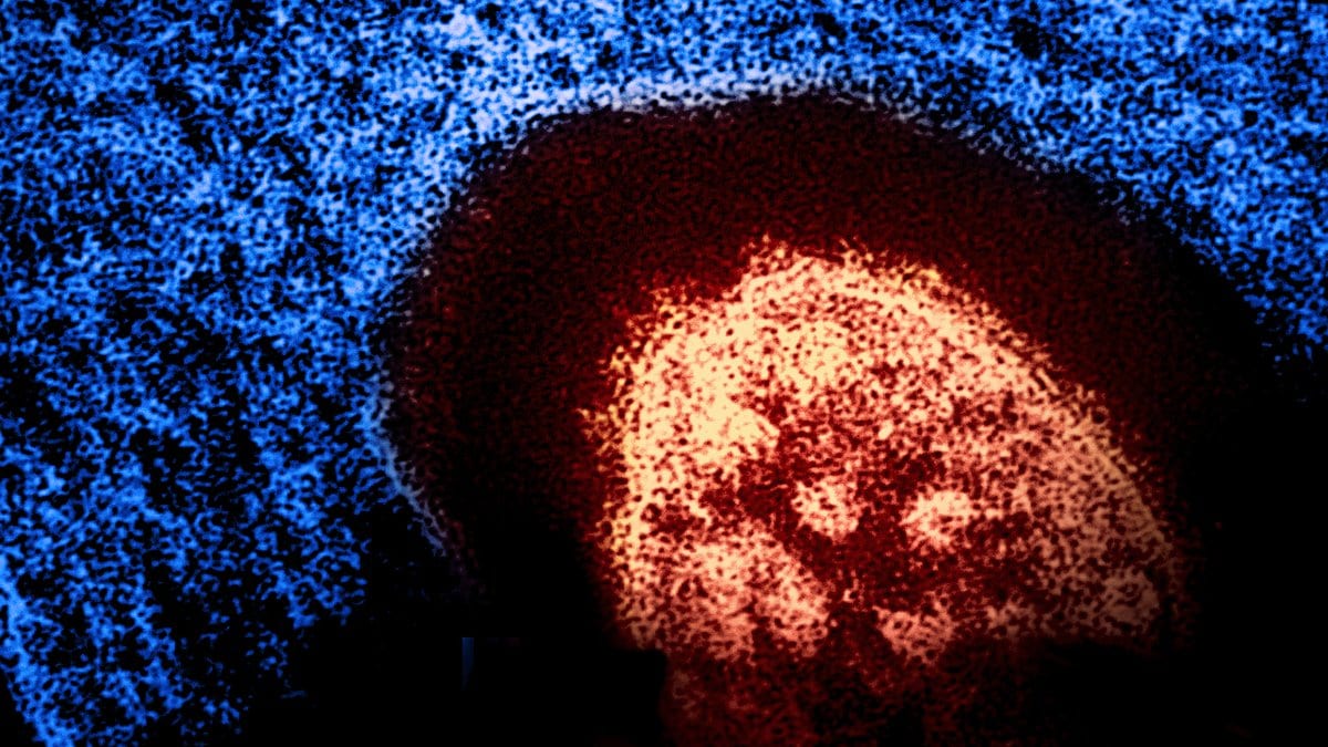 Colorized micrograph of a cell infected with measles virus, showing a dense orange mass of viral material surrounded by blue cytoplasm.