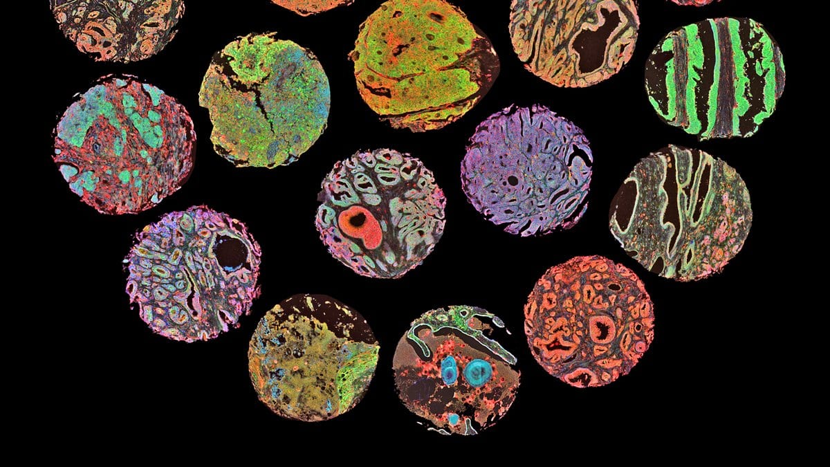 A cluster of circular cores of human tissue on a black background, each core brightly colored by fluorescent antibody staining.