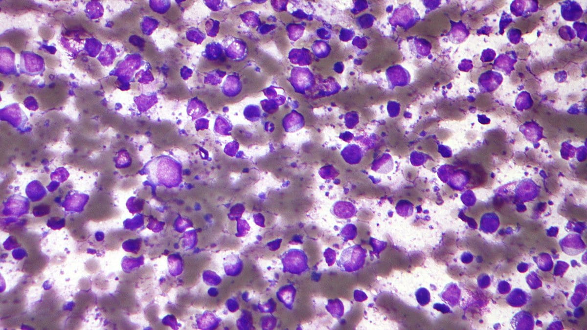 Light micrograph of a stained smear crowded with large purple-stained lymphoma cells.