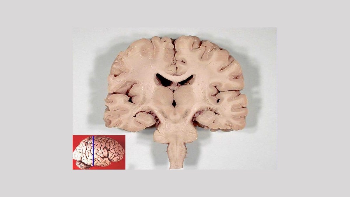Photograph of a preserved human brain cut in a vertical slice through both hemispheres, showing folded cortex, the ventricles and deep gray matter.