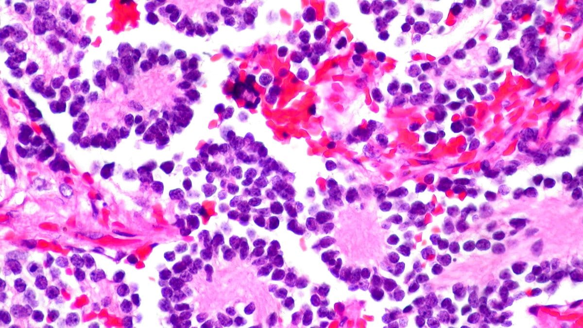 Photomicrograph of stained neuroblastoma tissue, with clusters of small, dark purple tumor cells ringed around pale centers and separated by pink strands of tissue.