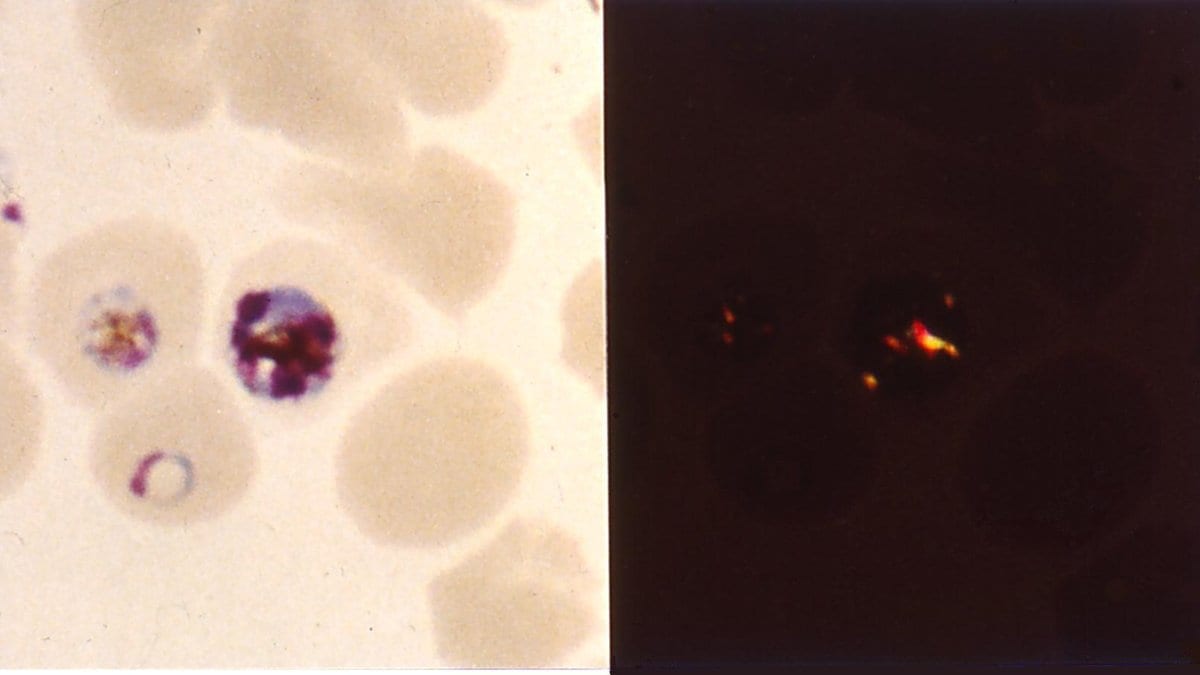Side-by-side light micrographs of malaria-infected red blood cells: at left, stained cells holding dark pigment grains; at right, the same kind of field under polarized light, where the grains shine as bright orange-yellow specks.