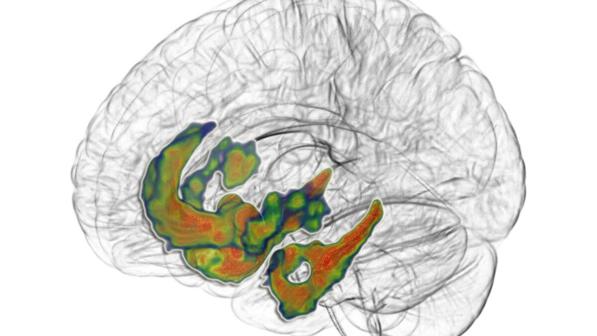A three-dimensional rendering of a human brain with PET signal shown in green, yellow and red across deep central structures.