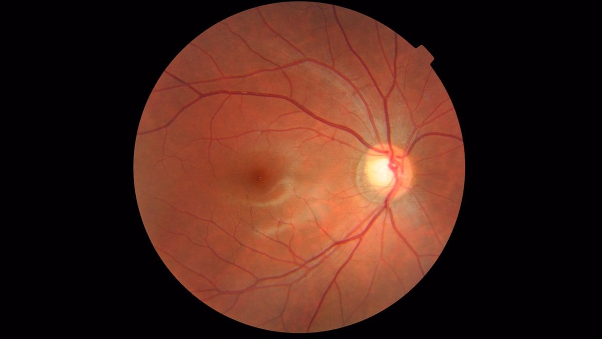 A color fundus photograph of a healthy human retina: a bright optic nerve head at right, with blood vessels fanning out across an orange-red background.