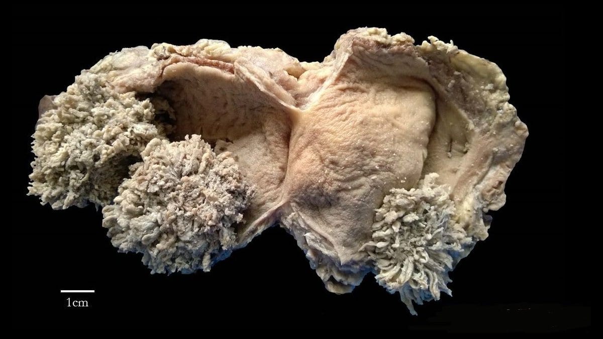 A surgical specimen of an opened bladder showing cauliflower-like tumors growing from the inner lining, with a 1 cm scale bar at lower left.