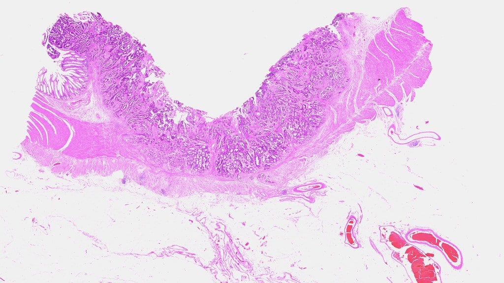 A whole-mount microscope section of a colon adenocarcinoma, the tumor forming a thick purple band across the bowel wall.