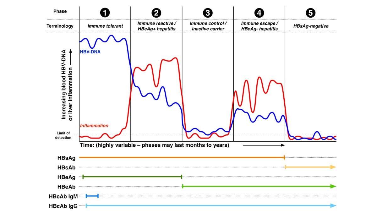Line chart of blood HBV DNA and liver inflammation across five phases of chronic hepatitis B infection, with bars below marking when each blood marker, including hepatitis B surface antigen, is present.