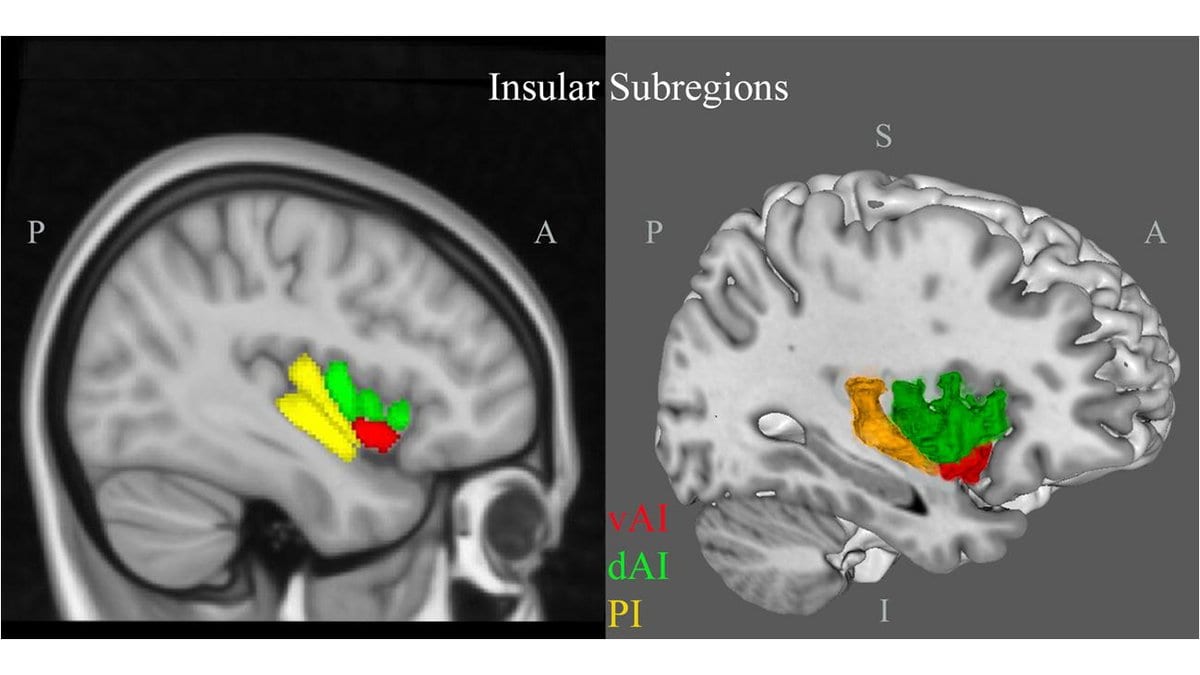 Magnetic resonance images of a human brain with colored overlays marking three divisions of the insular cortex.