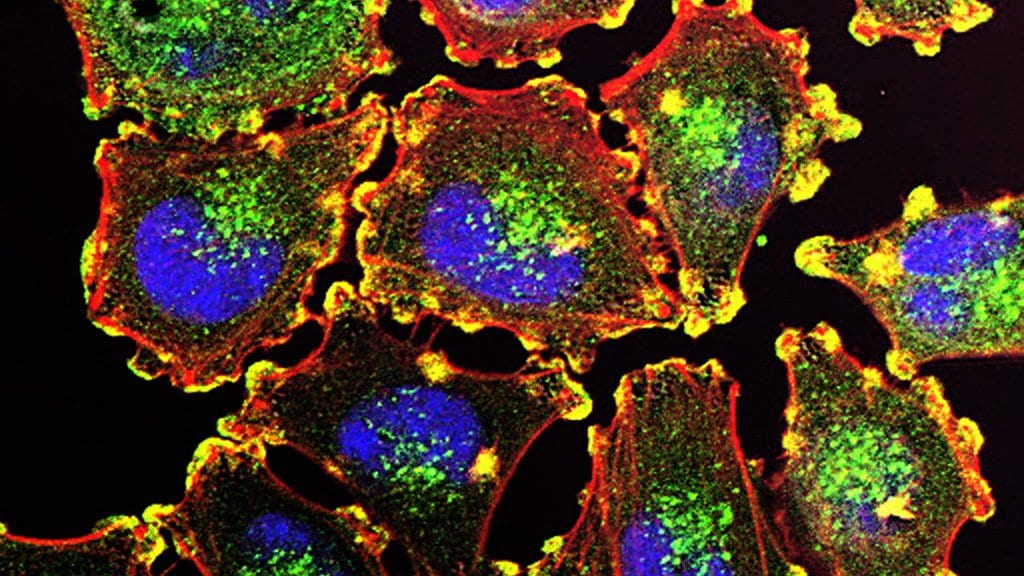 Fluorescence micrograph of cultured human melanoma cells, each with a blue nucleus inside a green and red stained cell body against a black background
