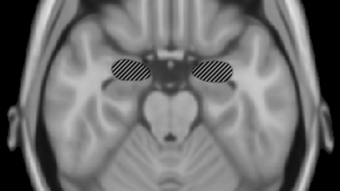 Axial section of a human brain, with the left and right amygdala marked by hatched ovals deep in the temporal lobes.