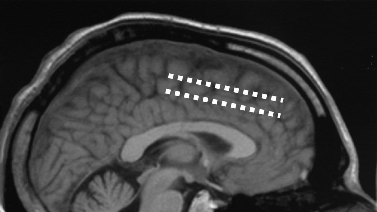 A sagittal MRI scan of a human head in which two rows of small implanted electrode contacts appear as bright dots resting on the surface of the cortex.