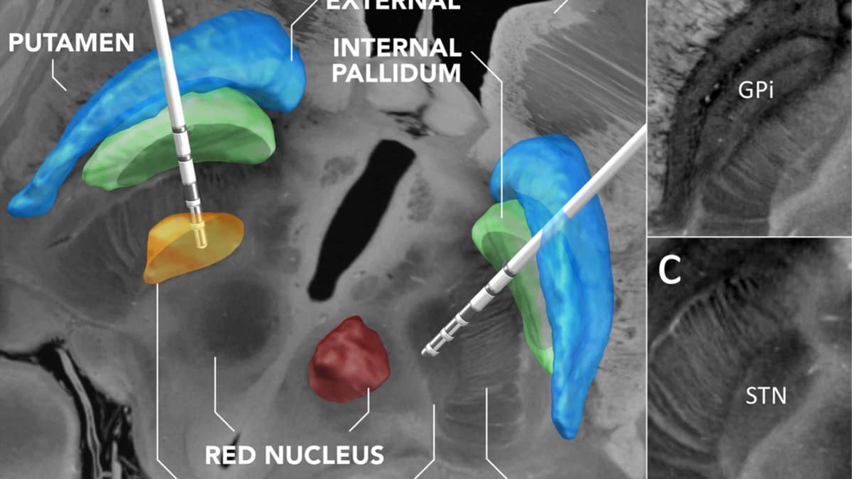 A labelled anatomical figure: coloured 3D models of the putamen, pallidum and red nucleus overlaid on a greyscale MRI slice, with two stimulation electrodes and inset views