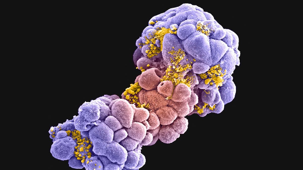 Color-enhanced scanning electron micrograph of a cluster of breast cancer cells treated with the chemotherapy drug doxorubicin, the cells shown in purple and pink with yellow debris on their surfaces.